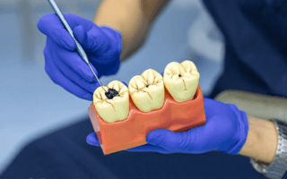 اسباب تسوس الاسنان رغم تنظيفها