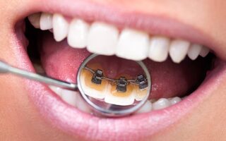 انواع تقويم الاسنان