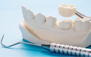 تركيب الاسنان الامامية