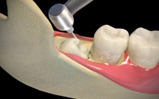 ماهو ضرس العقل