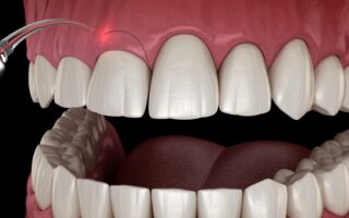 استئصال اللثة