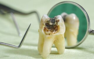 الأسنان الميتة