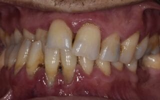 العضة المعكوسة للاسنان