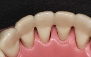 تركيب الاسنان المتحركة