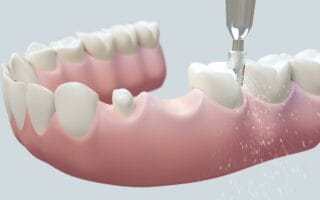 تركيب بورسلان للاسنان
