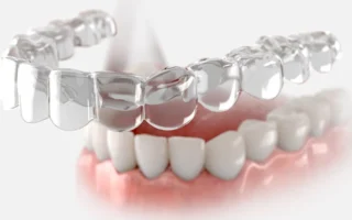 تقويم الاسنان الشفاف انفزلاين