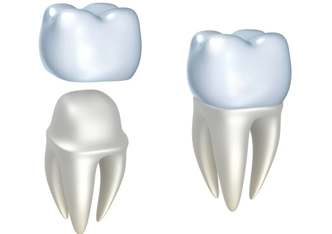تيجان الأسنان CEREC