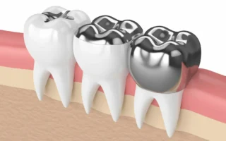 حشوات الأسنان