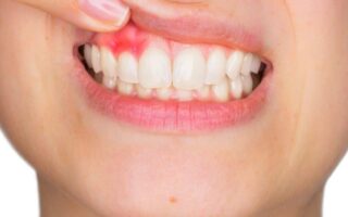 خراج الأسنان