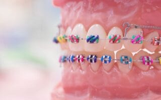 شروط تركيب تقويم الاسنان