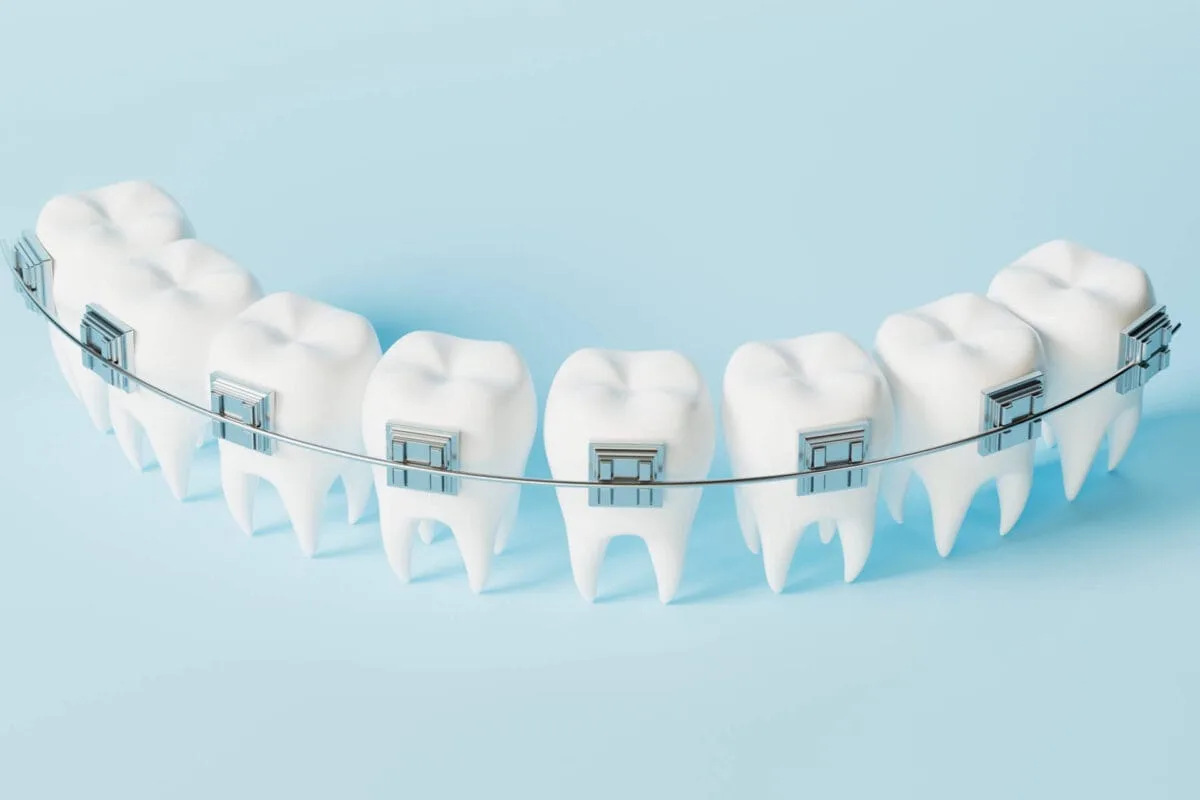 علاج تقويم الأسنان