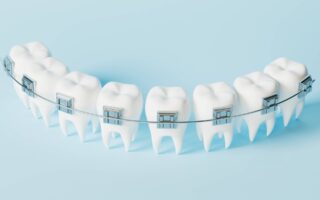 علاج تقويم الأسنان