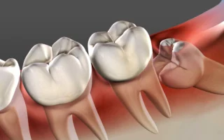 علاج ضرس العقل
