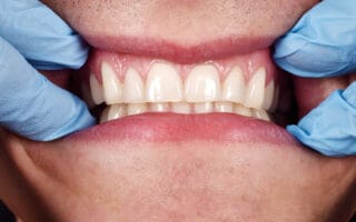 أمراض اللثة