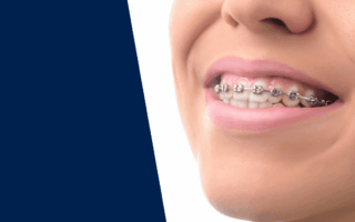 الحصول على تقويم الأسنان