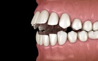 العضة المفتوحة