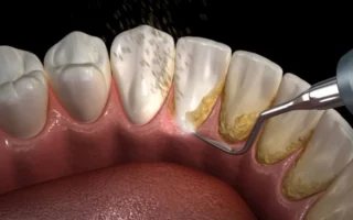 تحجيم الأسنان