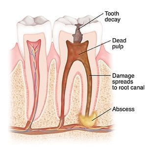 التسوس للعصب