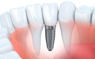 طرق زراعة الاسنان