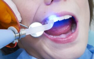 مانعات التسرب للأسنان