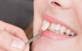 الغرض من قشور الأسنان