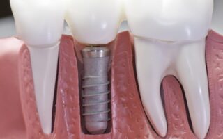 إجرائية علاج قناة جذر السن وكيف تتم