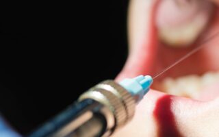 تخدير الأسنان