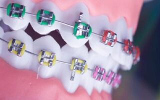 تركيب تقويم الأسنان