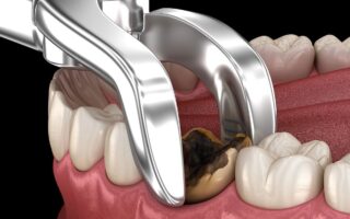 مضاعفات خلع الأسنان