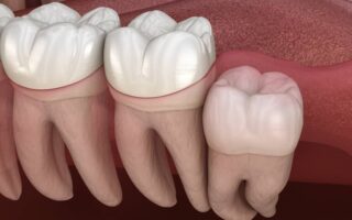 طرق تخفيف الألم من ضرس العقل