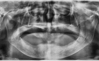 ترقيع العظام لزراعة الأسنان