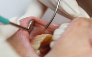 علاج اللثة بالليزر