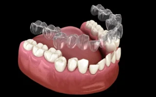 كم من الوقت يستغرق إنفزلاين لتقويم أسنانك الإجابة الكاملة