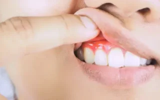 منع أمراض اللثة