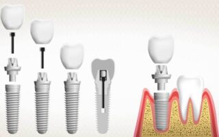 مواد زراعة الأسنان