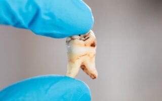 استعادة ضرس العقل