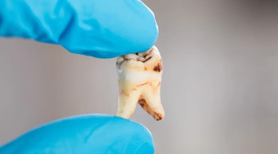 استعادة ضرس العقل