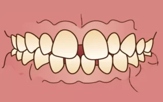 سوء إطباق الأسنان