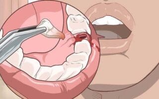 غرز ضرس العقل