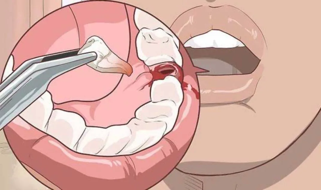 غرز ضرس العقل