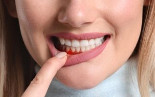 هل نزيف اللثة طبيعي