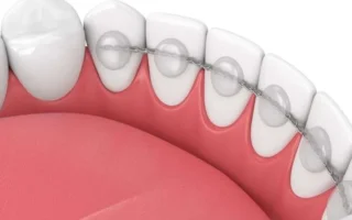 مثبت الأسنان بعد التقويم