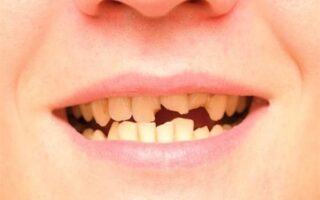 ترميم الاسنان المكسورة