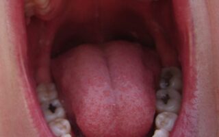 معالجة النخور في الأسنان