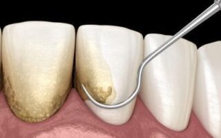 علاج جير الأسنان وكيفية إزالته