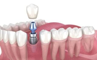 أسعار زراعة الأسنان في السعودية