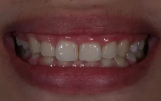 تثبيتات الأسنان المؤقتة