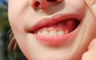 مدة شفاء خراج الاسنان