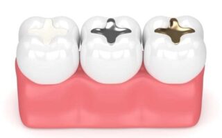 مميزات وعيوب حشو العصب