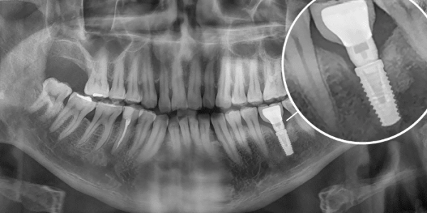 فشل زراعة الأسنان